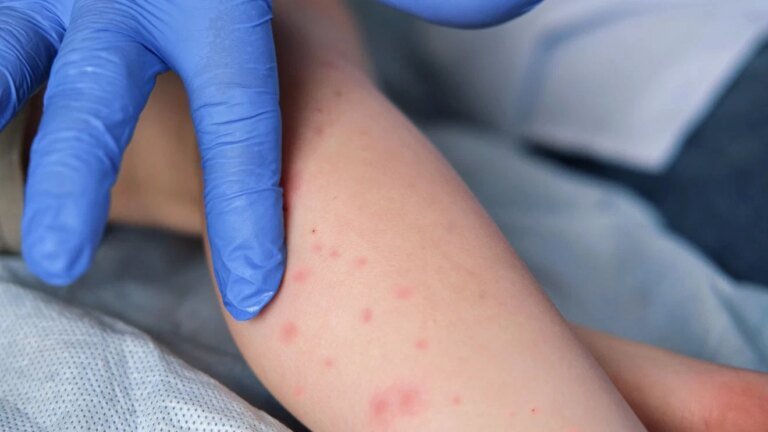Measles case confirmed in Pensacola area
